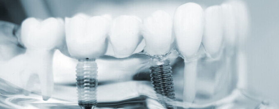 Röntgenbild zur Verbildlichung einer Zahnimplantologie der Zahnarztpraxis Waldstrasse in Erlangen
